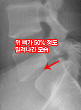 모커리한방병원 위 뼈가 50%정도 밀려나간 모습 이미지